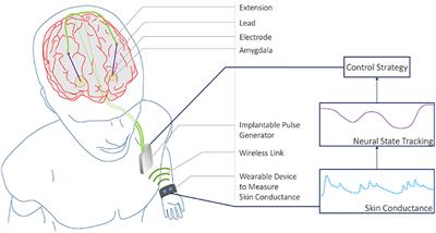 Skin Conductance as a Viable Alternative for Closing the Deep Brain Stimulation Loop in Neuropsychiatric Disorders